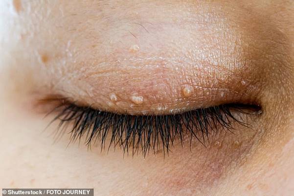 Skin tags can also indicate a potential diabetes diagnosis - especially those around the neck or on the eyelids
